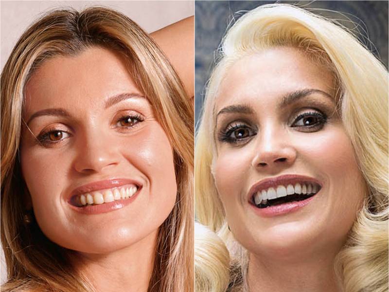 Febre dos famosos: saiba tudo sobre faceta e lente de ...
