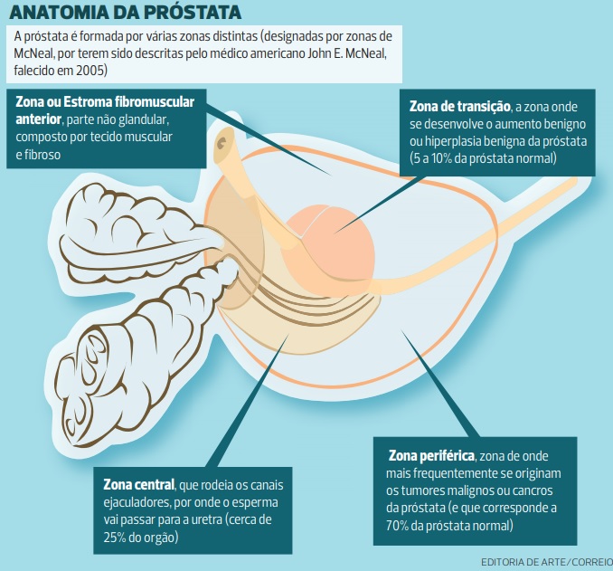 cancer prostata cu metastaze osoase si pulmonare