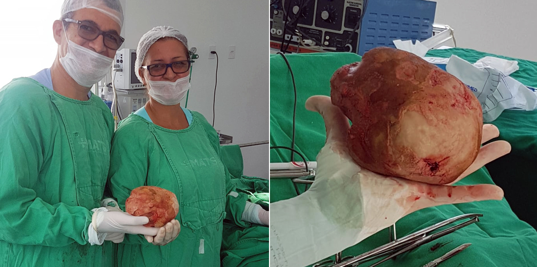 Recuperação De Cirurgia De Pedra Na Bexiga Baiano descobre em cirurgia que tinha pedra de quase 1,5 kg na bexiga